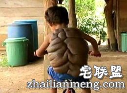哥伦比亚8岁男孩患怪病背似龟壳 半人半龟惊悚像怪兽！