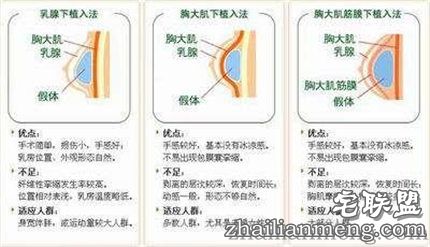 做隆胸手术安全吗?十大禁忌不可不知!