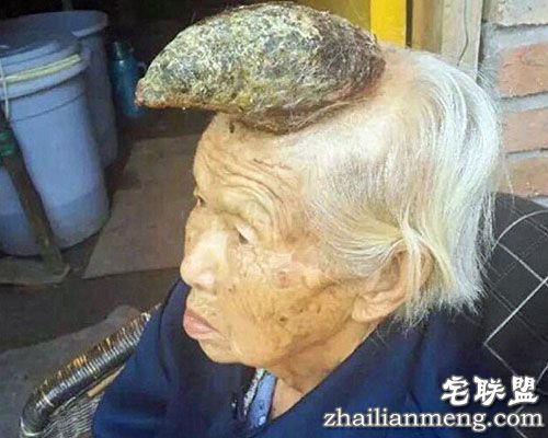 87岁老太头上长出13cm长“独角”让人称奇