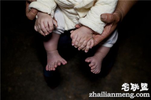 3个月大男婴患"多指症" 手指脚趾总共31根 惊呆了
