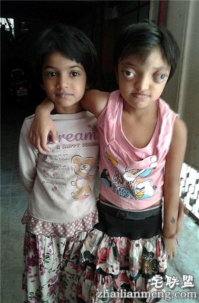 印度女孩患罕见病长”青蛙眼“ 饱受痛苦欺凌