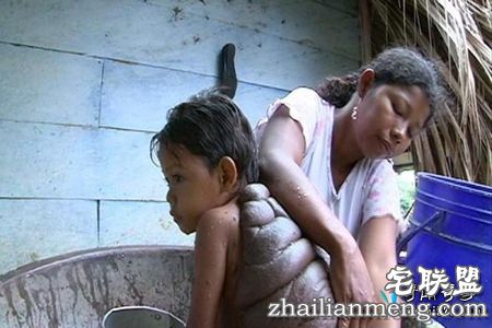 哥伦比亚8岁男孩患怪病背似龟壳 半人半龟惊悚像怪兽！