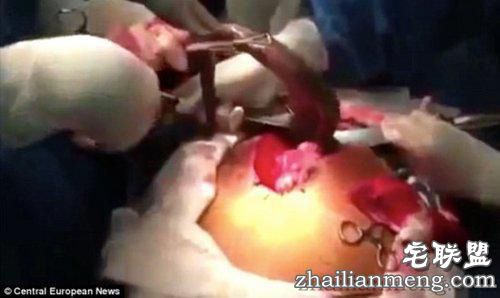 惊奇!男子体内取出一条活鱼 看到的让人全惊傻了！