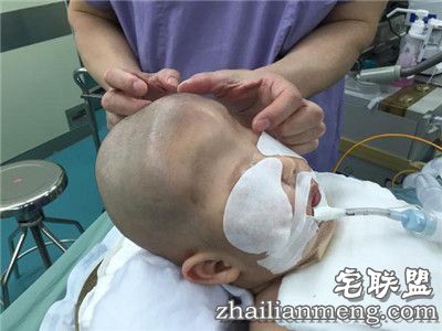 8个月男婴颅骨似外星人 网友:希望罕见疾病远离孩子们