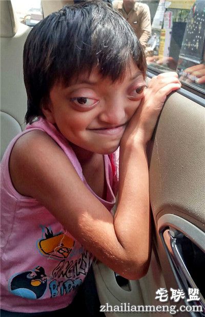 印度女孩患罕见病长”青蛙眼“ 饱受痛苦欺凌