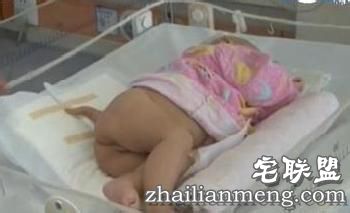 吓尿!幼童屁股长出尾巴 换尿不湿要提起小尾巴！