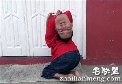 奇迹！畸形男：活着就能改变全球