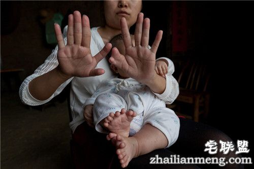 3个月大男婴患"多指症" 手指脚趾总共31根 惊呆了