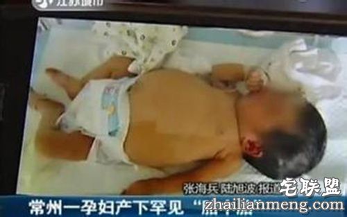 常州孕妇产下胎中胎 没想到女婴腹中还藏着胎儿！