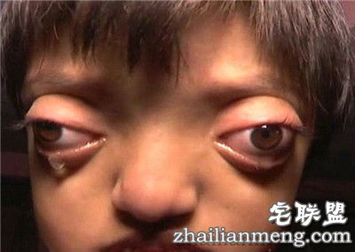 印度女孩患罕见病长”青蛙眼“ 饱受痛苦欺凌