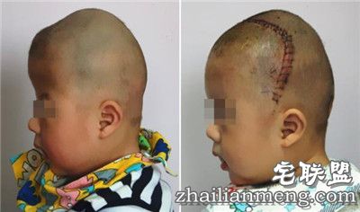 8个月男婴颅骨似外星人 网友:希望罕见疾病远离孩子们