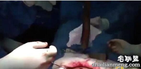 惊奇!男子体内取出一条活鱼 看到的让人全惊傻了！