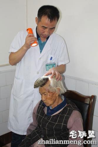 87岁老太头上长出13cm长“独角”让人称奇