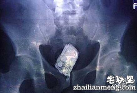 女子产后肚子震动真相曝光!竟是医生将手机落腹中！