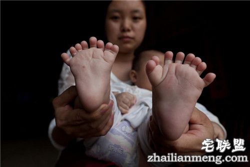 3个月大男婴患"多指症" 手指脚趾总共31根 惊呆了