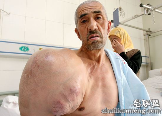 现实版!男子右肩长如绿巨人的“巨型肌肉”