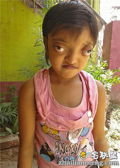 印度女孩患罕见病长”青蛙眼“ 饱受痛苦欺凌