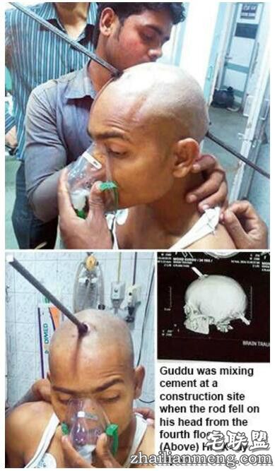 印度一男子头部被2米多长钢筋刺穿奇迹生还！