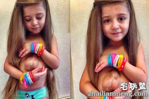 俄罗斯女孩天生心脏长在胸腔外 被称"天使之心"