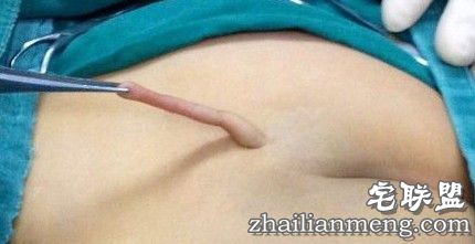 吓尿!幼童屁股长出尾巴 换尿不湿要提起小尾巴！