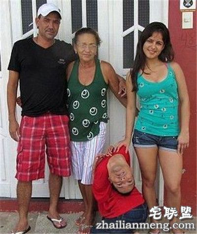 奇迹！畸形男：活着就能改变全球