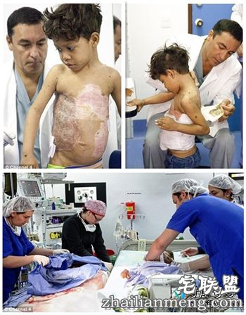 哥伦比亚8岁男孩患怪病背似龟壳 半人半龟惊悚像怪兽！