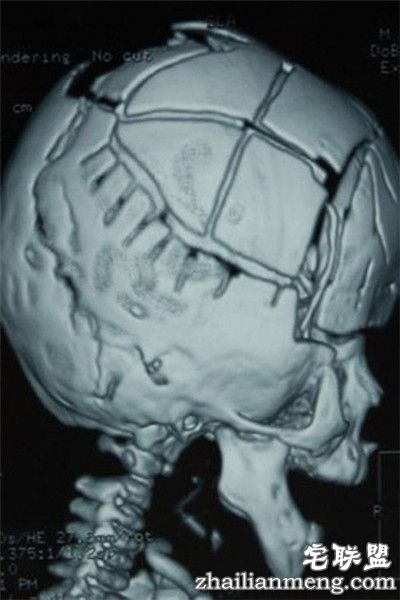 8个月男婴颅骨似外星人 网友:希望罕见疾病远离孩子们