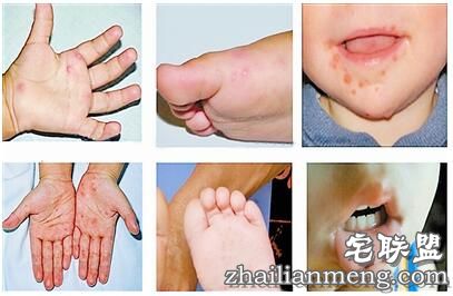 香港爆发手足口病 手足口病初期症状及预防