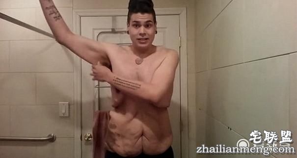 226公斤小伙猛减122公斤赘肉，但减肥成功后却不敢脱下衣服