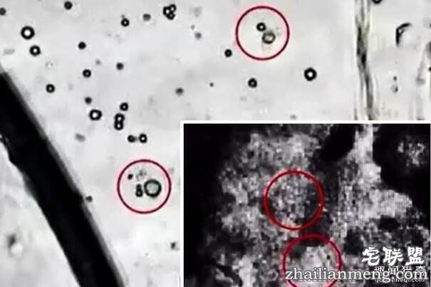 惊悚!2男童吃螃蟹 肺脑遭寄生虫吃光