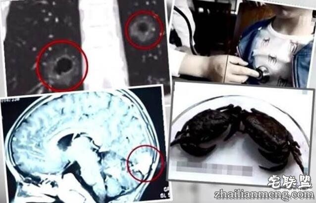 惊悚!2男童吃螃蟹 肺脑遭寄生虫吃光