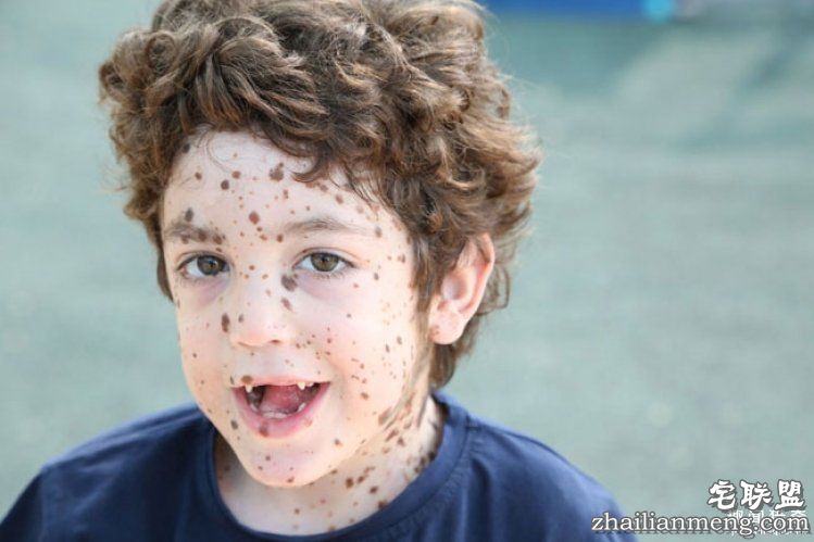 8岁男孩脸上长满胎记被嘲笑，网友的反应好有爱