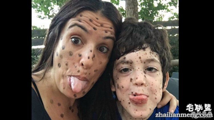 8岁男孩脸上长满胎记被嘲笑，网友的反应好有爱