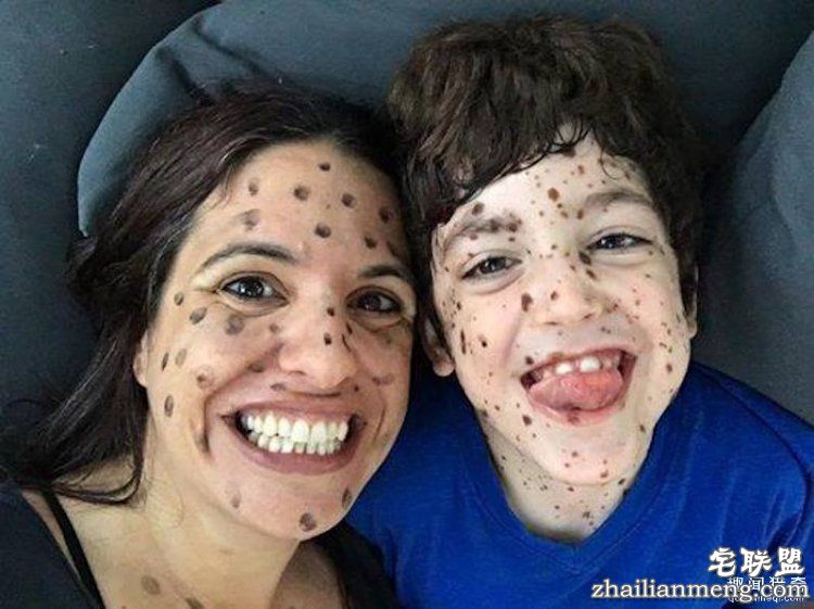 8岁男孩脸上长满胎记被嘲笑，网友的反应好有爱