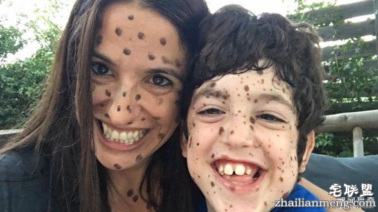 8岁男孩脸上长满胎记被嘲笑，网友的反应好有爱