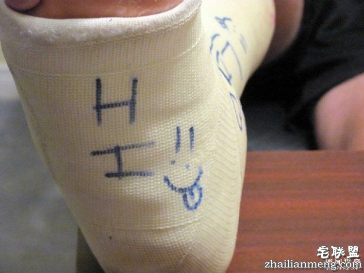 被吸尘器打断，被医生掰折…18位网友分享他们奇葩的骨折原因