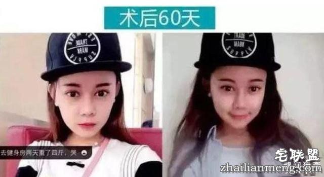 女孩花百万变身“重庆版Angelababy”，整容前后对比，惊呆了！！！