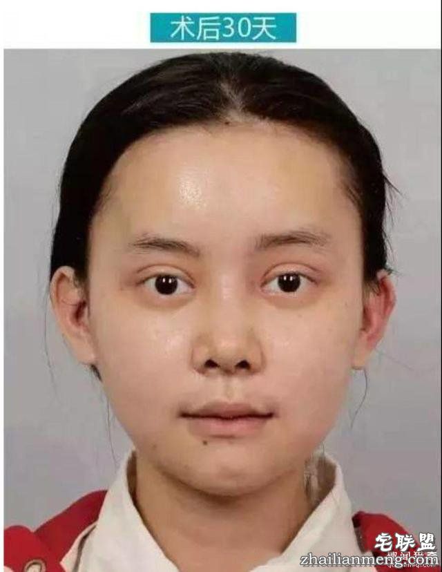女孩花百万变身“重庆版Angelababy”，整容前后对比，惊呆了！！！