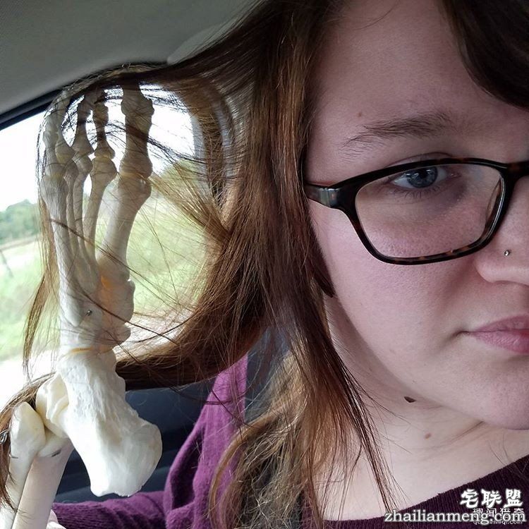 女孩被截肢后，天天拿着自己的脚骨自拍