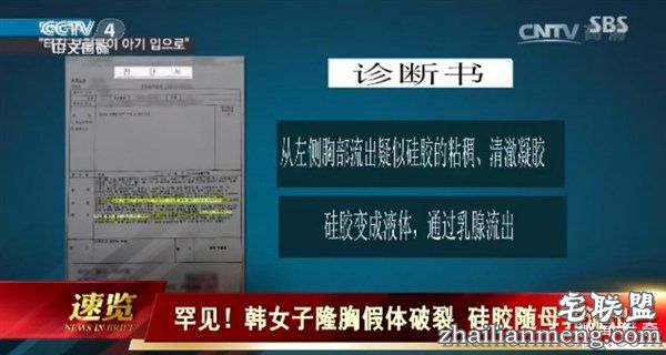 韩国女子隆胸5年假体破裂 硅胶随母乳流出被孩子吃下