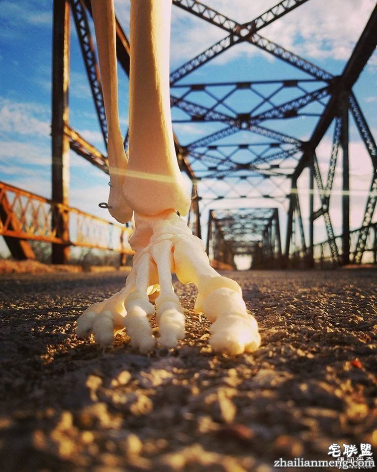 女孩被截肢后，天天拿着自己的脚骨自拍