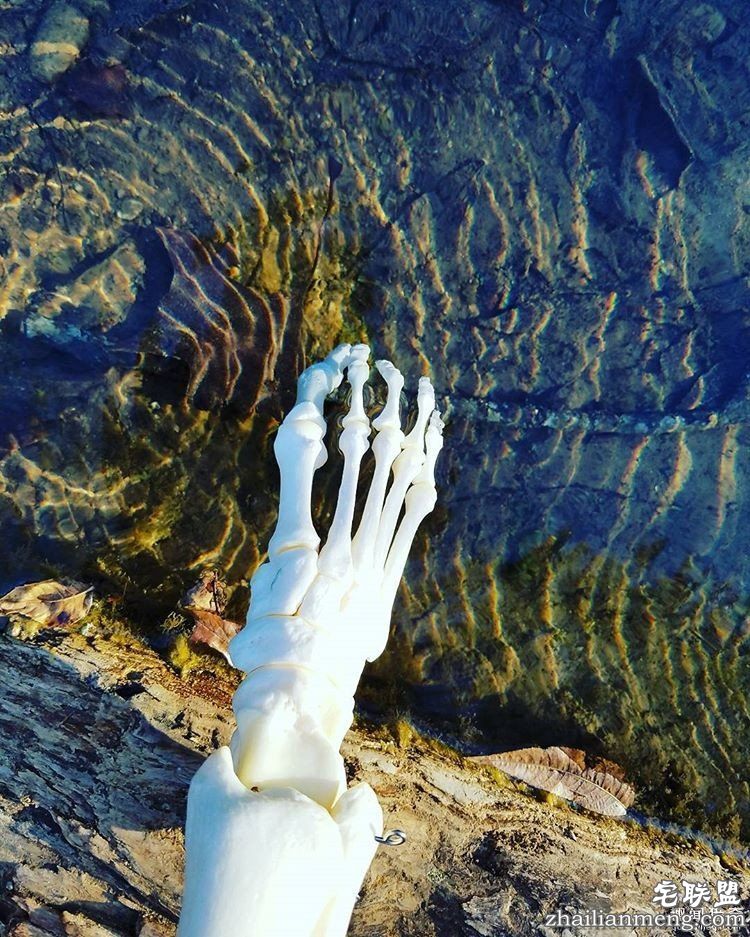 女孩被截肢后，天天拿着自己的脚骨自拍