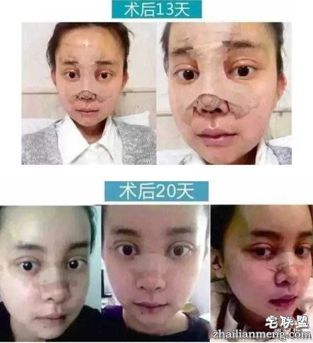 女孩花百万变身“重庆版Angelababy”，整容前后对比，惊呆了！！！