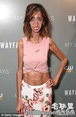 丽兹（Lizzie Velasquez）
