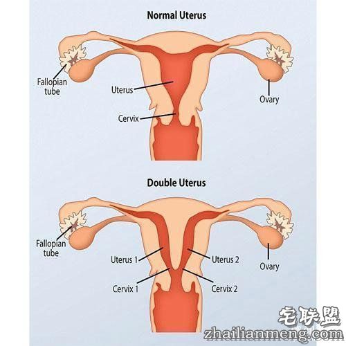 英国女子多年不孕，原来是双阴道双子宫，夫妻俩没找对地方