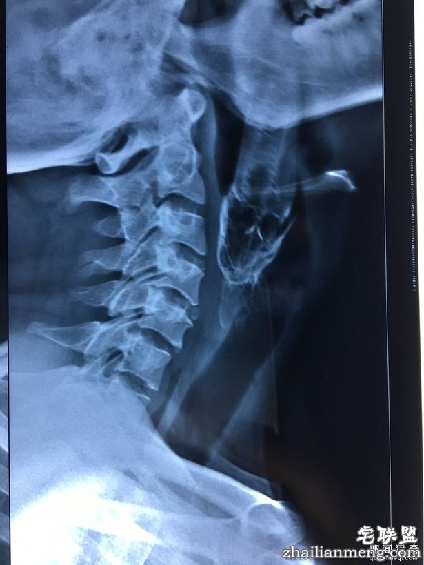 男子「活鱼卡喉咙」痛苦快死，医生「拉出整条画面」大傻眼!