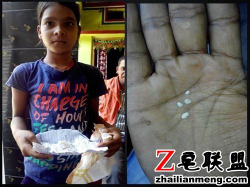 印度11岁女孩眼睛每天掉出白色小石子被称“棉花泪”