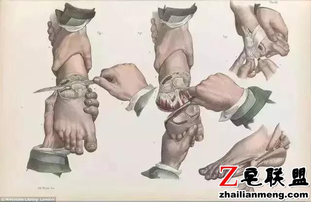 西方外科黑历史，理发师垄断手术只会放血，医生掘墓解剖练手速