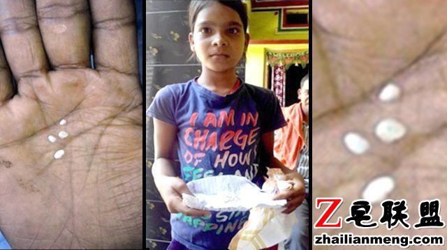 印度11岁女孩眼睛每天掉出白色小石子被称“棉花泪”